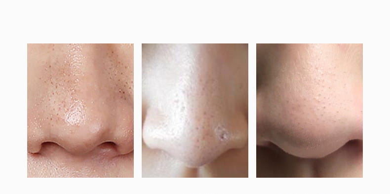 A close-up of a nose showing three stages of skin texture improvement using a handheld digital iontophoresis personal care device with care negative iontophoresis for clearer pores and smoother skin.