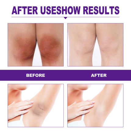 EELHOE Rejuvenator Areola Intimate Area Rejuvenator Lip Joints Melanin Removal - Royalessencelux