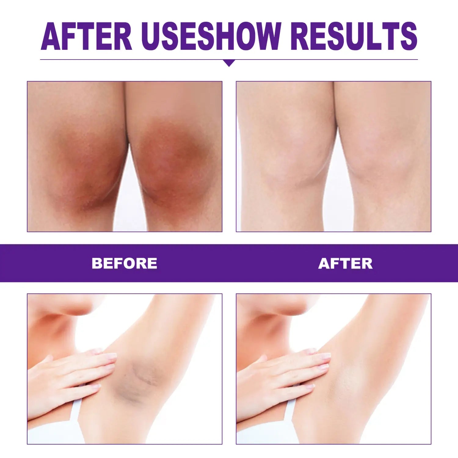 the image shows a before-and-after comparison of skin discoloration on knees and underarms demonstrating the effects of eelhoe rejuvenator areola intimate area essence for reducing discoloration and brightening the areola intimate area.