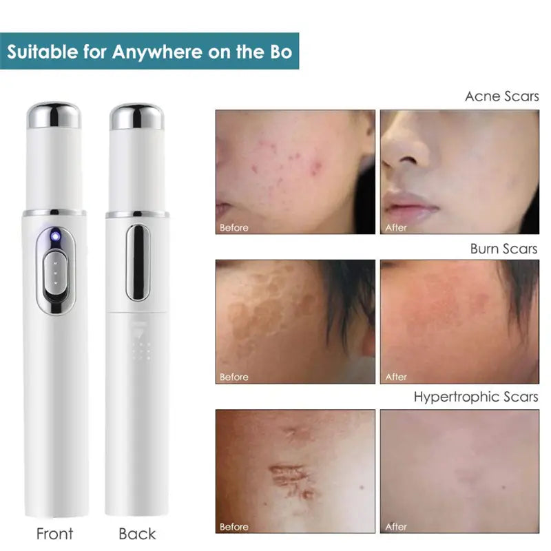 White handheld LED blue light therapy acne laser pen with silver accents and a blue indicator light for light therapy acne treatment.