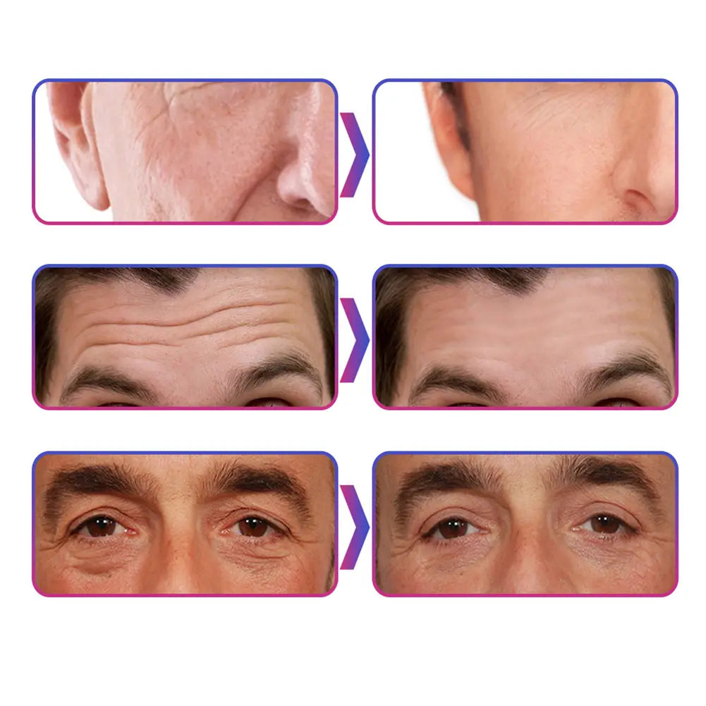 Before-and-after close-up collage showing facial skin rejuvenation with wrinkles around the nose and forehead significantly reduced using men’s moisturizing nourishing skin collagen cream.