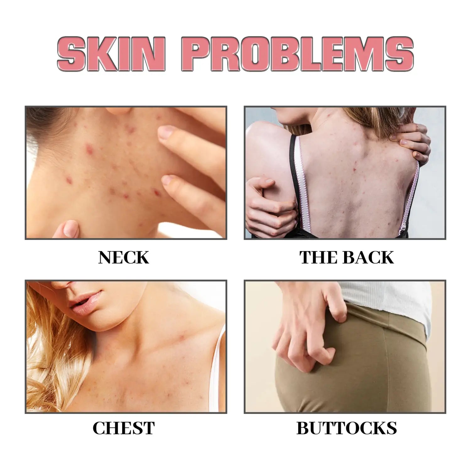 the image shows four distinct skin problems on the neck, back, chest, and buttocks treated with pink heart exfoliating bath soap that removes acne effectively.