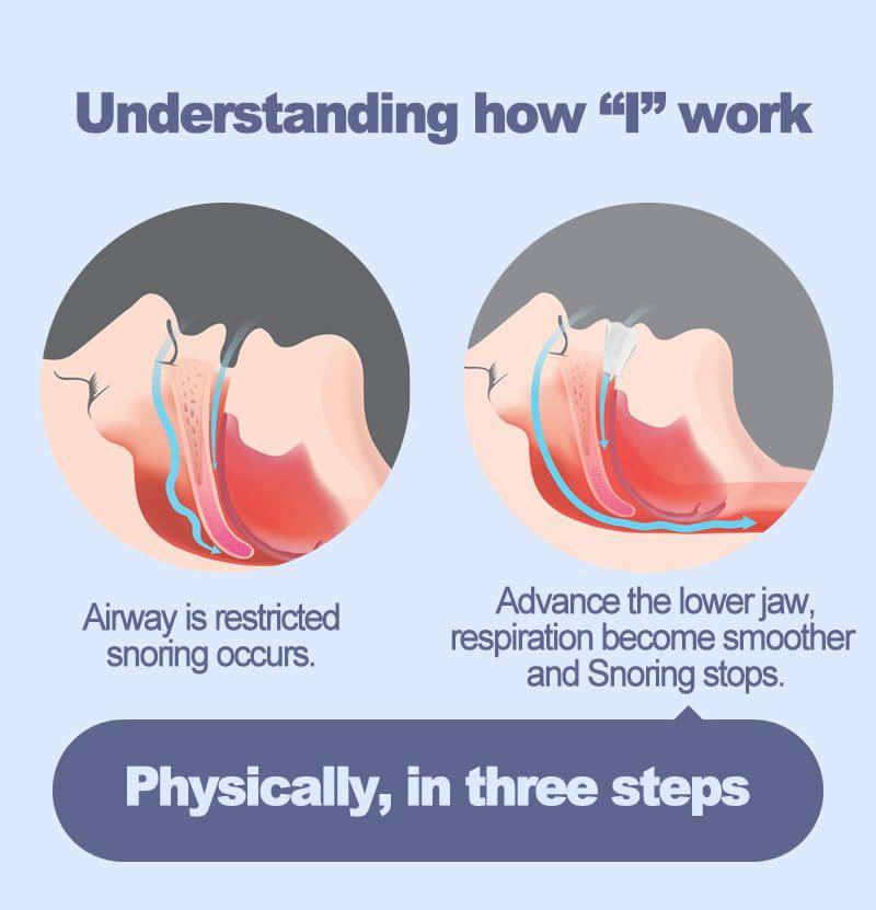 Adjustable Anti Snoring Mouth Guard Anti-Snoring Mouthpiece Sleeping Devices Bruxism Snoring Stopper Improve Sleep Mouthpiece Button Full Cup Plus Size Bra Without Wi Royalessencelux