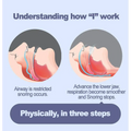 An illustrated diagram showing how an adjustable anti snoring mouth guard improves airflow by advancing the lower jaw
