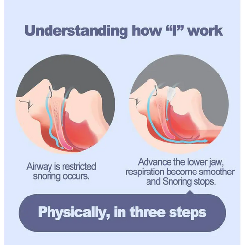 An illustrated diagram showing how an adjustable anti snoring mouth guard improves airflow by advancing the lower jaw