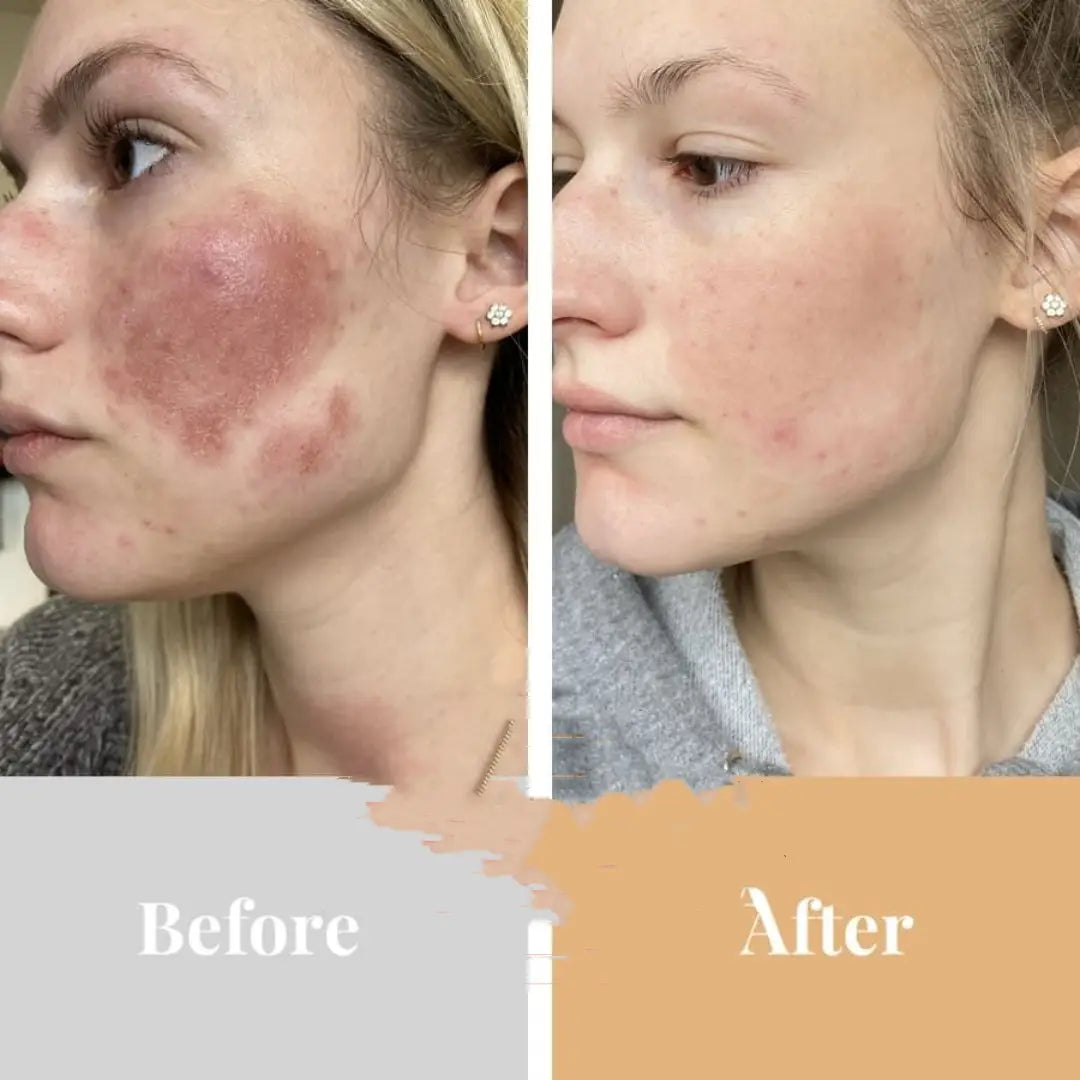 a woman’s face showing noticeable improvement in skin tone and texture from before to after using the Minilux collagen anti aging beauty instrument.