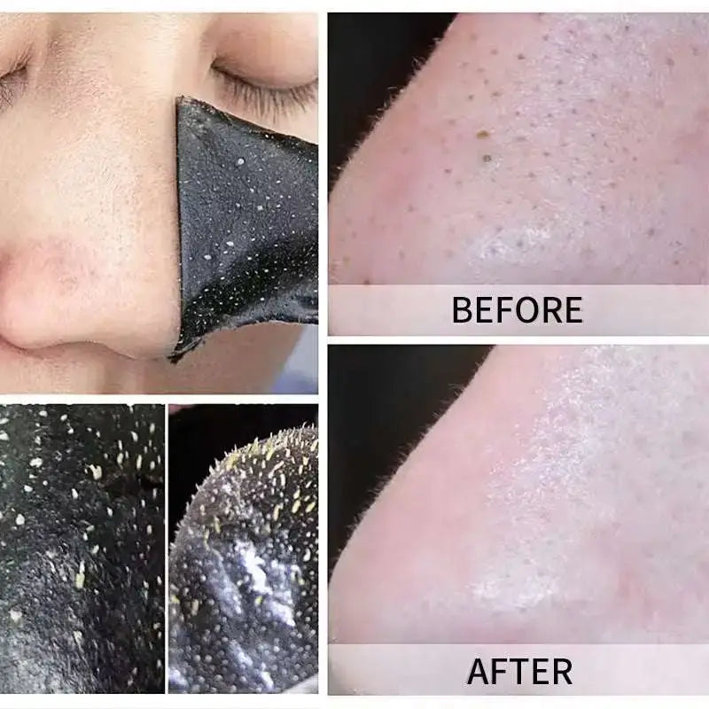 Nasal Sticker Shrink And Clean Pores Blackhead Acne Skin Care Products Button Full Cup Plus Size Bra Without Wi Royalessencelux
