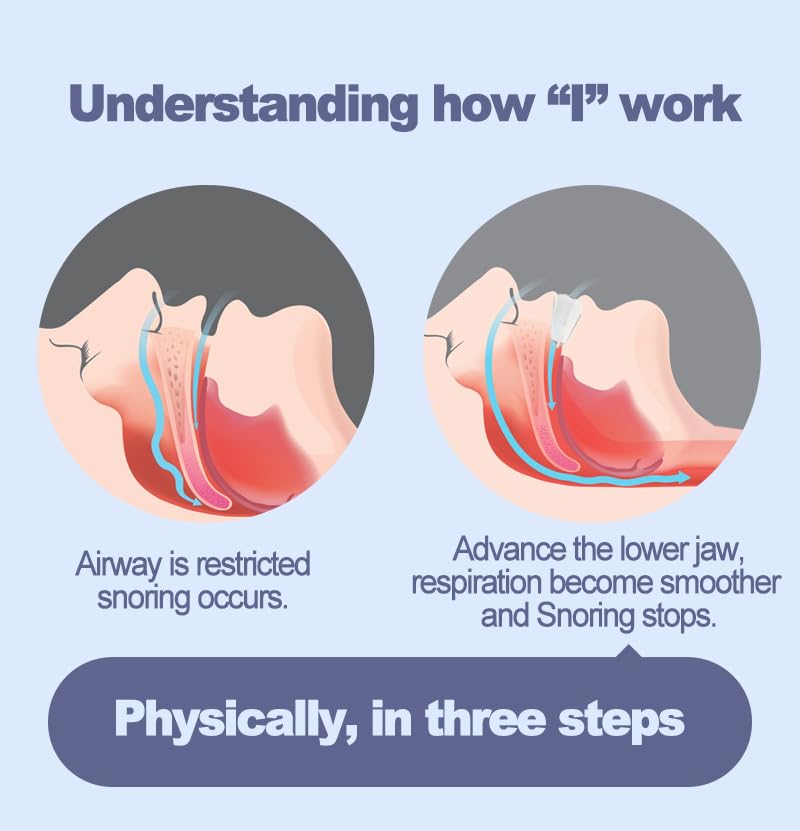An illustrated diagram showing two circular cross-sections of a human head depicting anatomical airway changes during snoring and after using an adjustable anti snoring mouth guard.