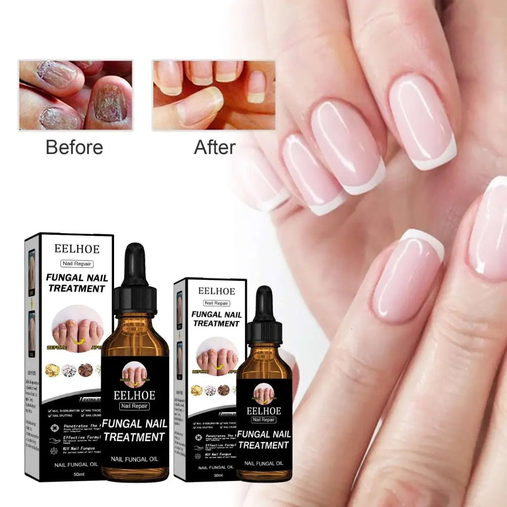 Eelhoe nail repair liquid fungal treatment 50ml in amber glass dropper bottles with before and after nail results
