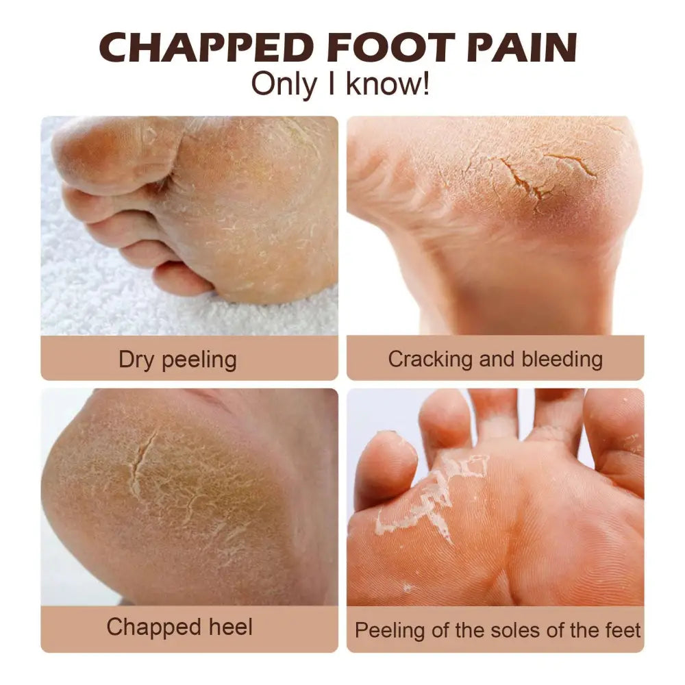 Dry cracked skin on feet and hands illustrating chapped foot pain treated by eelhoe natural horse oil foot cream