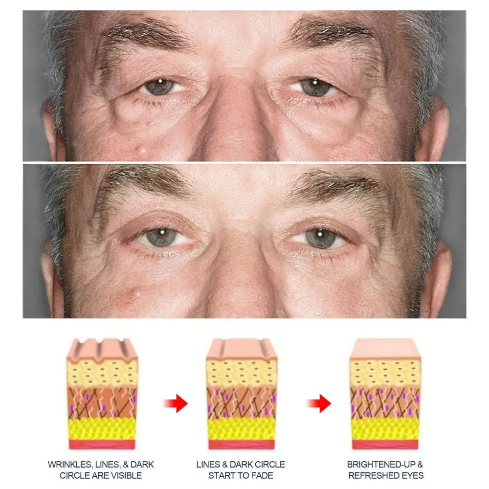 Before and after of a man’s eyes showing reduced wrinkles and brightened skin using men’s anti-aging eye cream with awaken peptide lifting