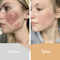 Before and after using minilux collagen anti aging beauty instrument with white face mask showing clearer skin results