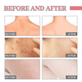 Before and after skin clarity and texture improvement with pink heart-shaped exfoliating bath soap that removes acne