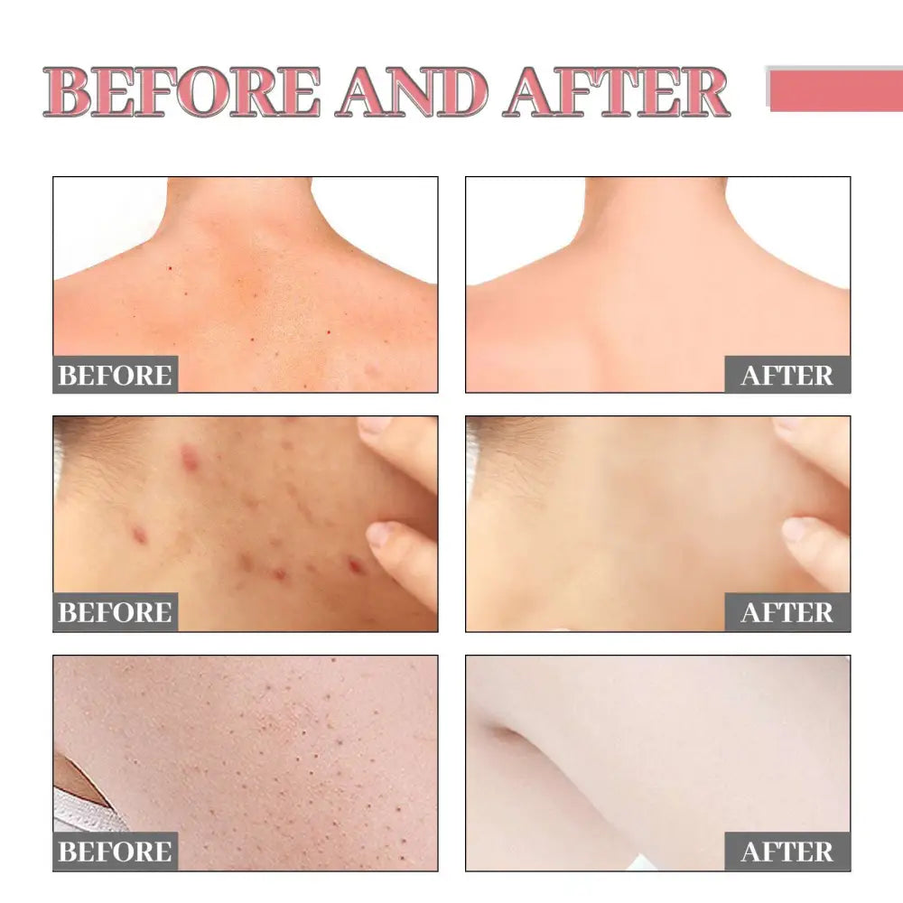 Before and after skin clarity and texture improvement with pink heart-shaped exfoliating bath soap that removes acne