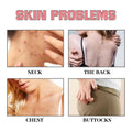 Infographic showing pink heart-shaped exfoliating bath soap removes acne from neck back chest and buttocks skin problems