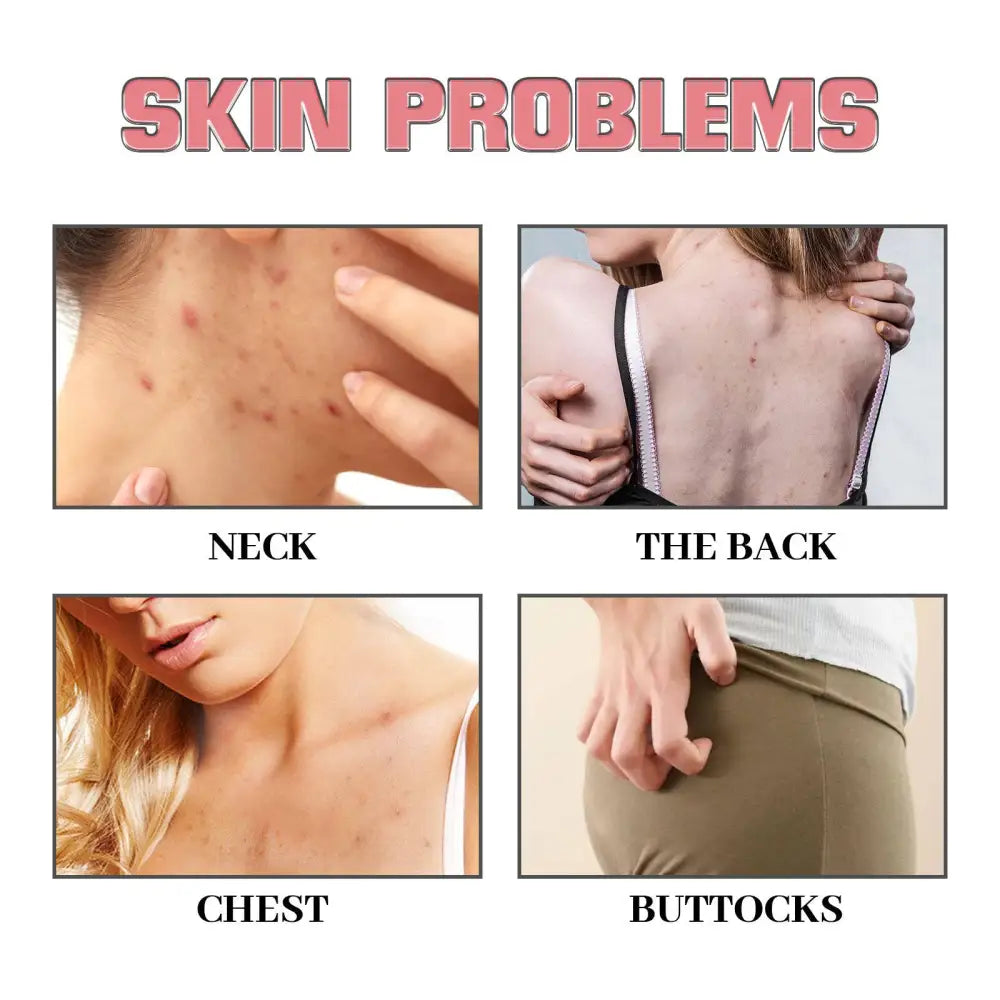 Infographic showing pink heart-shaped exfoliating bath soap removes acne from neck back chest and buttocks skin problems