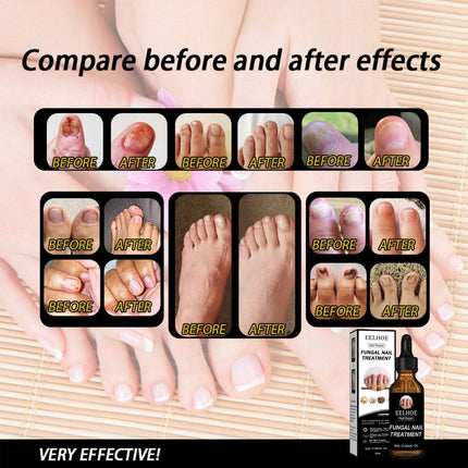 EELHOE Nail Repair Liquid Thickening, Brightening, Whitening, Repairing, Moisturizing, And Nourishing Nail Care Liquid - Royalessencelux