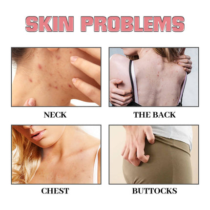 Exfoliating Bath Soap Removes Acne, Lightens Acne Marks, Moisturizes The Skin And Cleanses The Soap - Royalessencelux