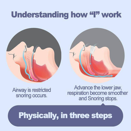 Adjustable Anti Snoring Mouth Guard Anti-Snoring Mouthpiece Sleeping Devices Bruxism Snoring Stopper Improve Sleep Mouthpiece - Royalessencelux