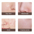 Close-up panels show oily skin, blackheads, acne, and coarse pores treated by ultrasonic skin scrubber exfoliating device