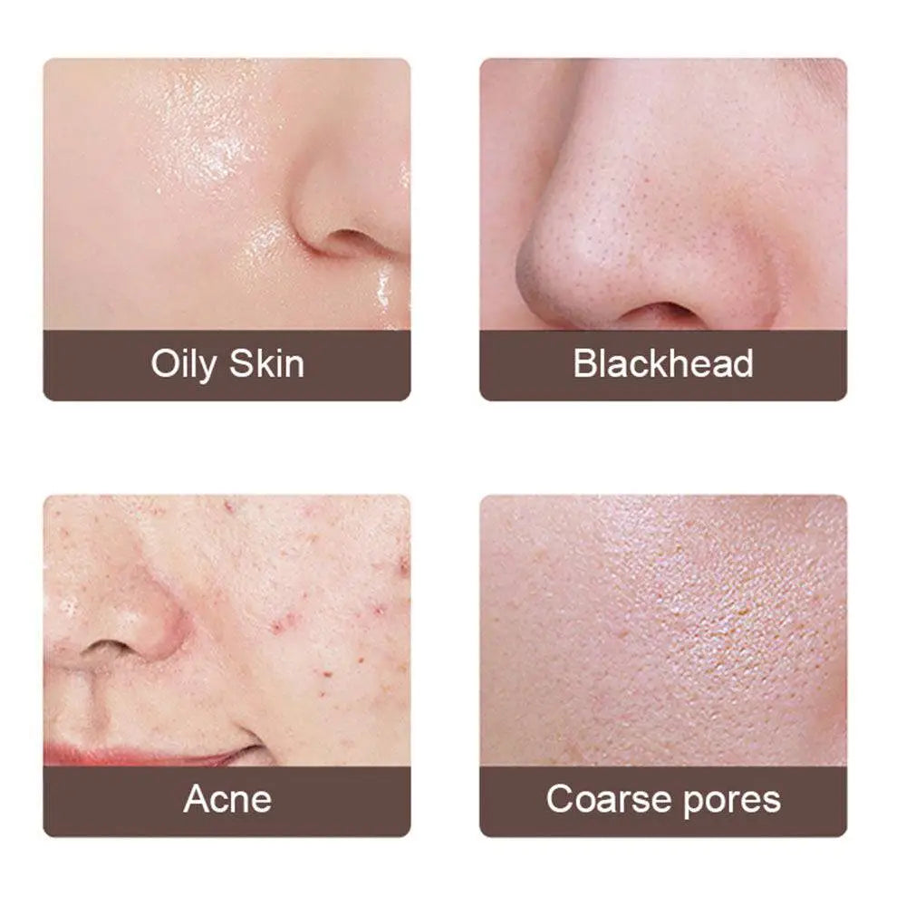 Close-up panels show oily skin, blackheads, acne, and coarse pores treated by ultrasonic skin scrubber exfoliating device